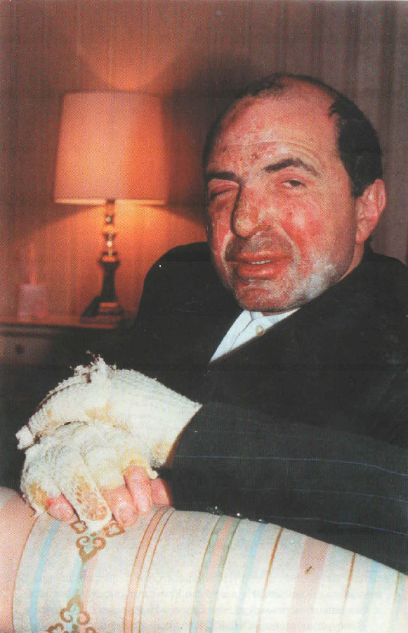 581x900, 173 Kb / Борис Березовский, покушение, ожег, бинт, пиджак, лампа