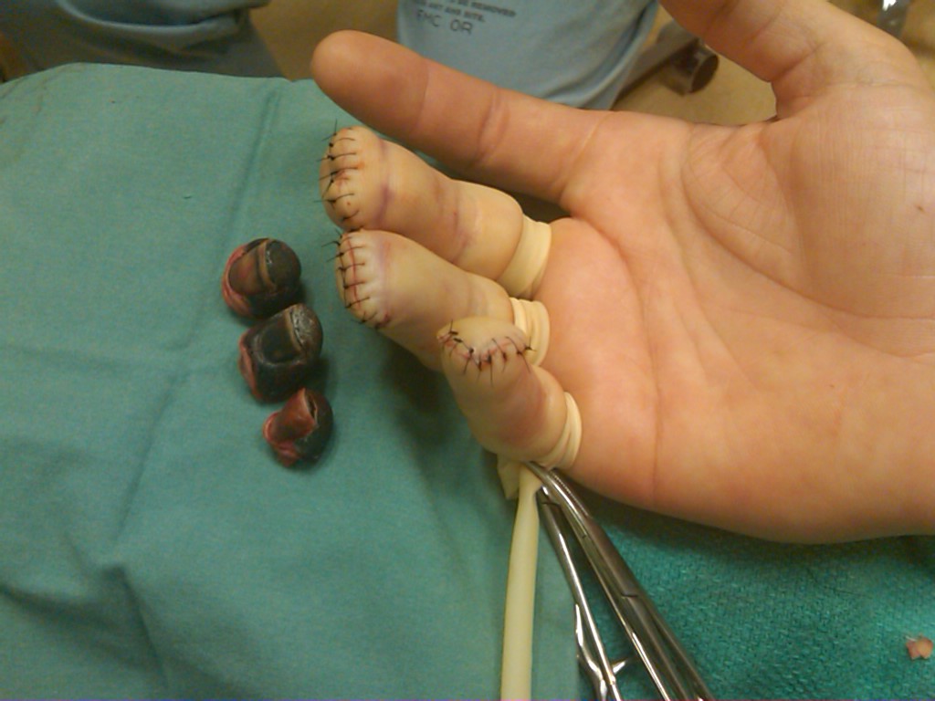 1024x768, 117 Kb / швы, пальцы, ампутация